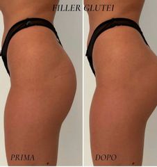 Filler glutei - Dr. Raoul Novelli