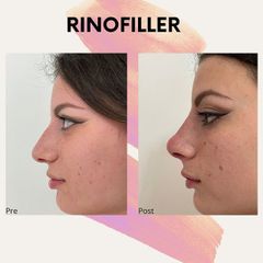 Rinofiller - Dr. Raoul Novelli