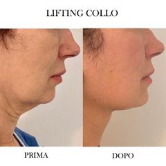 Lifting collo - Dr. Raoul Novelli