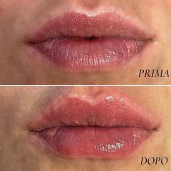 Filler labbra - Dr. Raoul Novelli