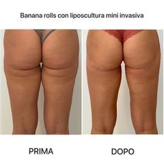 Liposuzione - Dr. Raoul Novelli