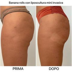Liposuzione - Dr. Raoul Novelli