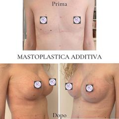 Mastoplastica additiva - Dr. Raoul Novelli