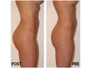 Gluteoplastica - Dr. Raoul Novelli