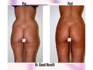 Gluteoplastica - Dr. Raoul Novelli