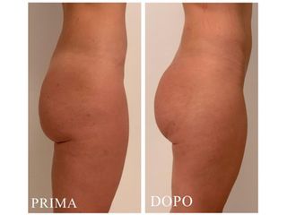 Gluteoplastica - Dr. Raoul Novelli