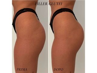 Gluteoplastica - Dr. Raoul Novelli
