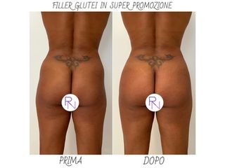 Gluteoplastica - Dr. Raoul Novelli