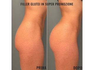 Gluteoplastica - Dr. Raoul Novelli