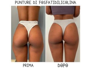 Gluteoplastica - Dr. Raoul Novelli