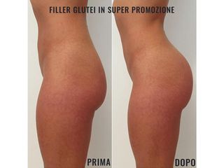 Gluteoplastica - Dr. Raoul Novelli