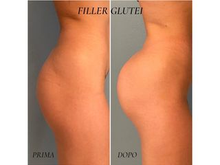 Gluteoplastica - Dr. Raoul Novelli