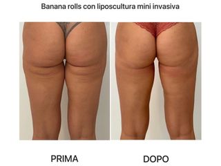 Liposuzione - Dr. Raoul Novelli