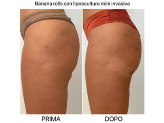 Liposuzione - Dr. Raoul Novelli