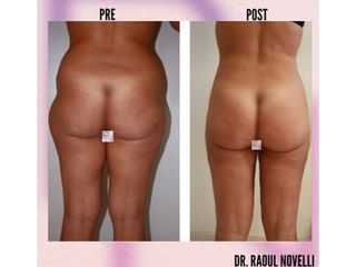 Liposuzione - Dr. Raoul Novelli