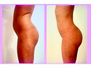 Liposuzione - Dr. Raoul Novelli