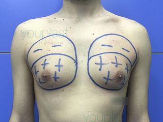 Youplast