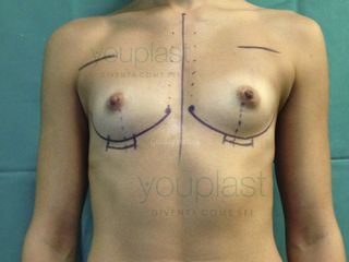 Youplast