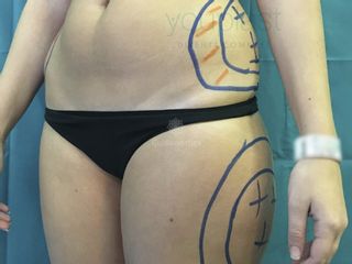 lipocaso1pre-angle-copiajpg_ci3.jpg