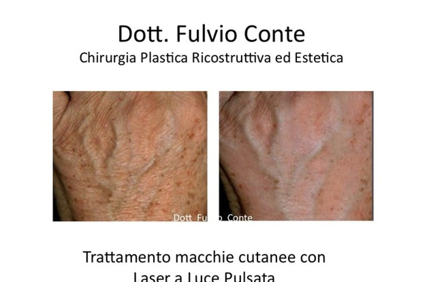 Macchie della pelle prima e dopo - 749811
