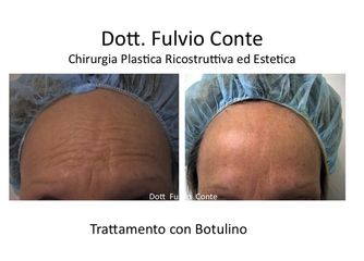 Botulino prima e dopo