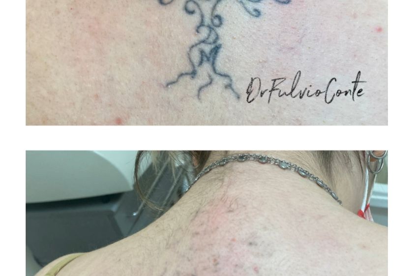 Rimozione tatuaggi prima e dopo - 811672