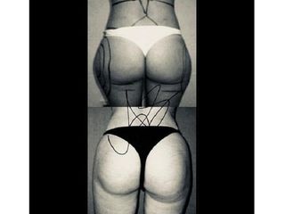 Liposcultura prima e dopo