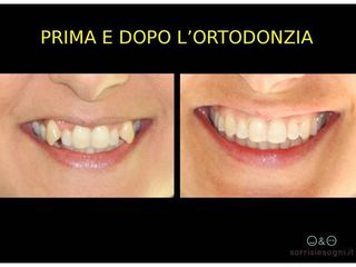 apparecchio dentale invisibile prima e dopo