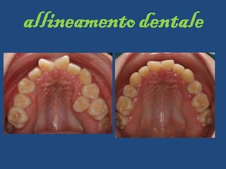 Allineamento dentale prima e dopo