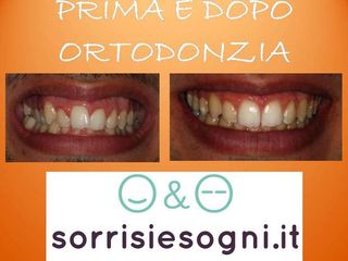 Apparecchio dentale prima e dopo