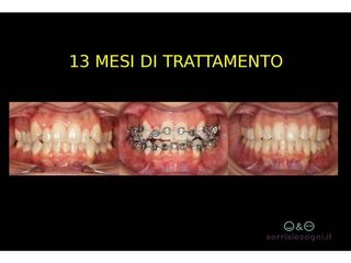 Prima e dopo trattamento ortodontico