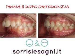 malocclusione prima e dopo