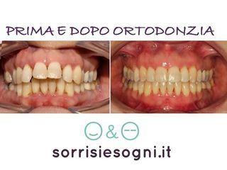 Ortodonzia prima e dopo