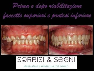 facette dentali prima e dopo