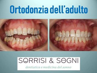 Apparecchio dentale prima e dopo