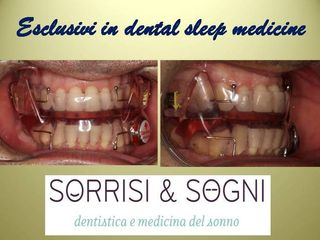 SORRISI & SOGNI apnee del sonno