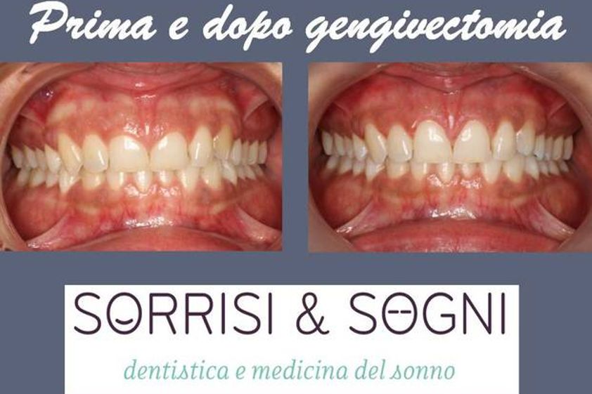 Laser dentale prima e dopo - 763857