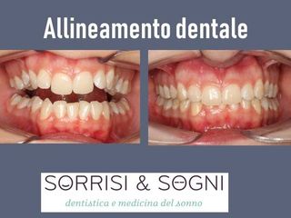 Prima e dopo apparecchio dentale