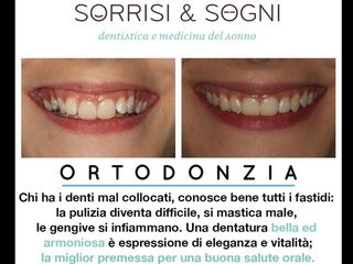 apparecchio dentale invisibile prima e dopo