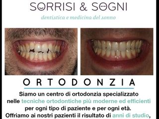 correzione dentale prima e dopo