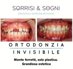 Apparecchio denti prima e dopo