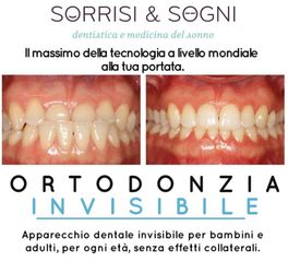 Apparecchio denti prima e dopo