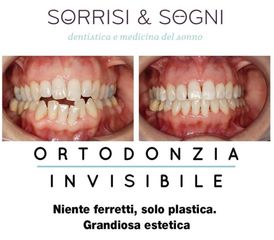 Apparecchio dentale prima e dopo