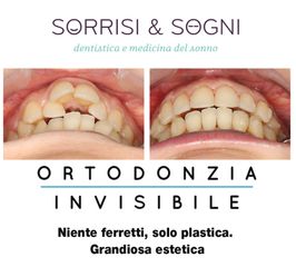 Apparecchio dentale prima e dopo