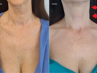 Mesoterapia prima e dopo - 869742