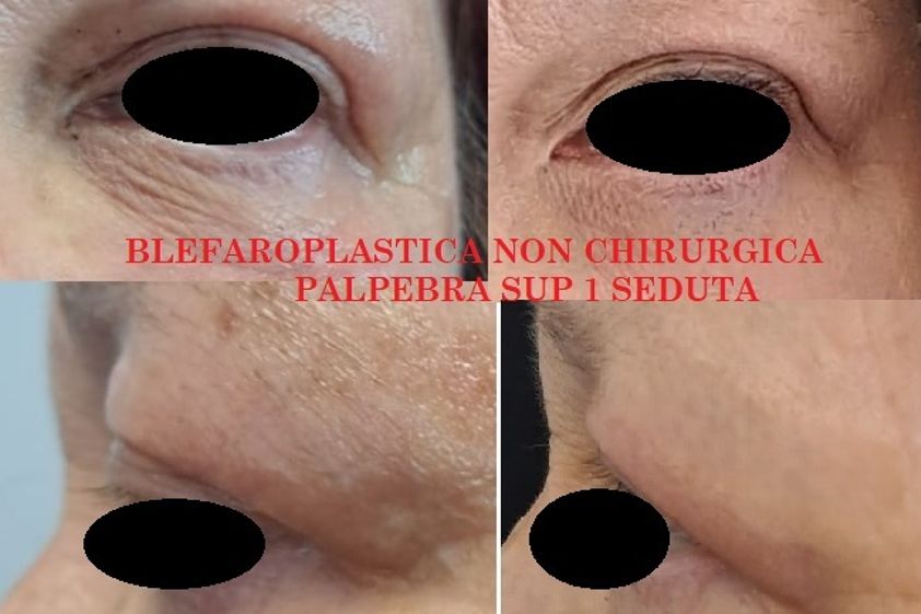 Blefaroplastica non chirurgica prima e dopo - 873793