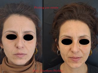 Peeling chimico prima e dopo - 874218