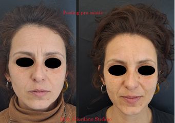Dott. Stefano Giordano peeling chimico