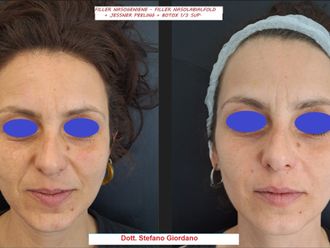 Filler prima e dopo - 874324