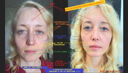 Dott. Stefano Giordano Blefaroplastica, Filler, Peeling,..